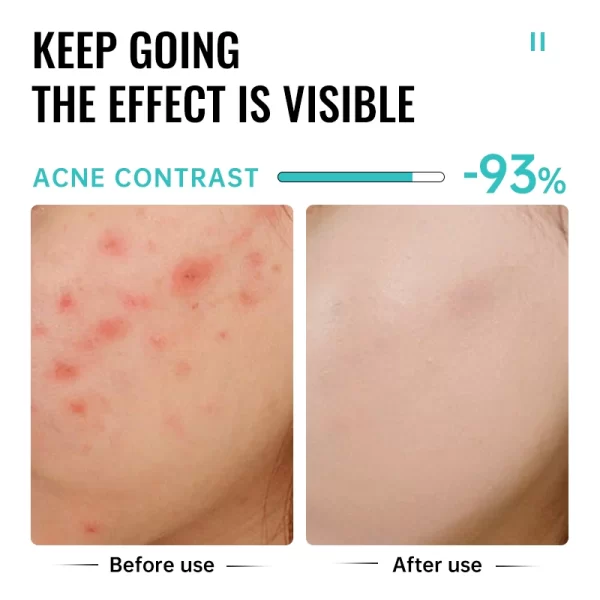 Salicylic Acid Acne Treatment Cream Repair Pimple Spots Deep Cleaning Pore Shrinking Anti-acne Oil Control Moisturizer Skin Care - Image 3