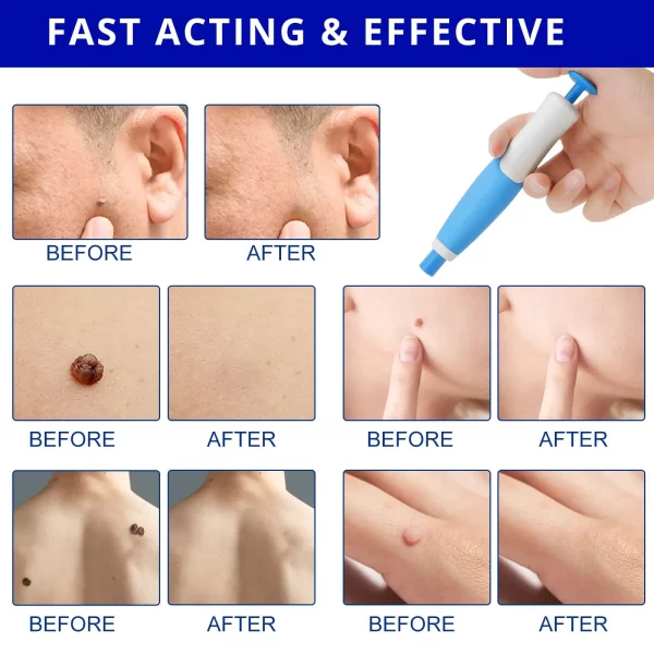 1 Set Auto Skin Tag Remover 2-8mm Band Painless Mole Wart Skin Tag Removal Pen Wart Dot Corn Treatments Body Facial Beauty Tool - Image 5