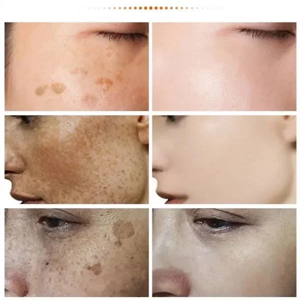 eelhoe Niacinamide Melasma Brightening Cream Reduce Melanin Brighten Cream Lighten Dark Skin Chloasma Serum Fade Fine Face Lines - Image 4