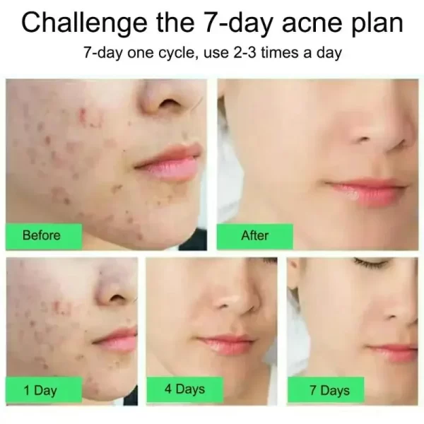 Salicylic Acid Acne Treatment Cream Repair Pimple Spots Deep Cleaning Pore Shrinking Anti-acne Oil Control Moisturizer Skin Care - Image 4