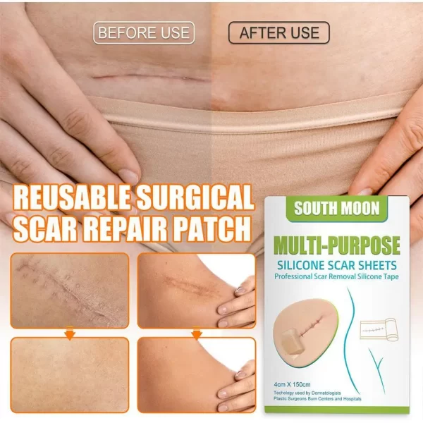 150cm Silicone Gel Scar Sheet Patch Treatment Removal Tape Acne Trauma Burn Scar Cover Skin Repair Section Ear Beauty - Image 3