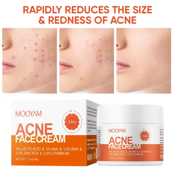Acne Treatment Cream Anti Acne Face Cream Pimple Removal Spots Oil Control Shrink Pores Moisturizing Skin Care Cream - Image 4