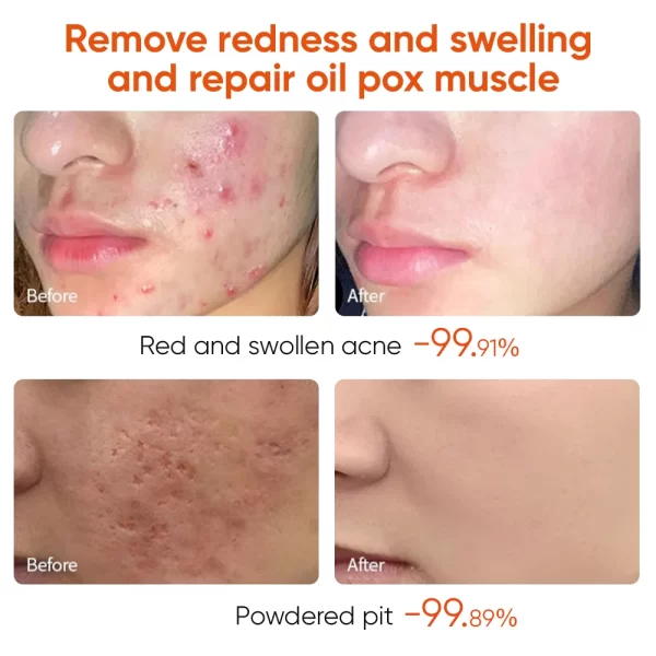 Acne Treatment Cream Anti Acne Face Cream Pimple Removal Spots Oil Control Shrink Pores Moisturizing Skin Care Cream - Image 2