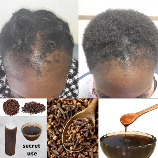 Africa Women Traction Alopecia Treatment Hair Loss Treatment Get Rid of Wigs Hair Growth Product for Men Shampoo 300ml Hair Care - Image 2