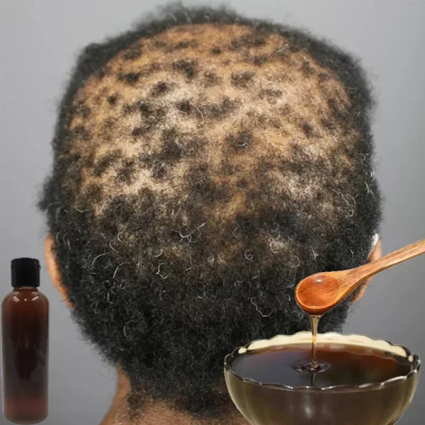 Africa Women Traction Alopecia Treatment Hair Loss Treatment Get Rid of Wigs Hair Growth Product for Men Shampoo 300ml Hair Care - Image 3